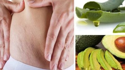 8 consejos para eliminar las estrias