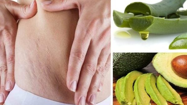 8 consejos para eliminar las estrias