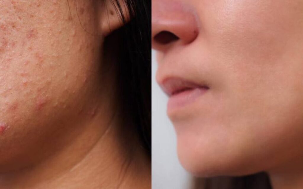 Acné Juvenil: Cómo Eliminar las Marcas 1 acne juvenil como eliminar las marcas