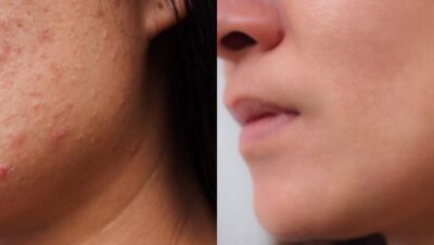 acne juvenil como eliminar las marcas