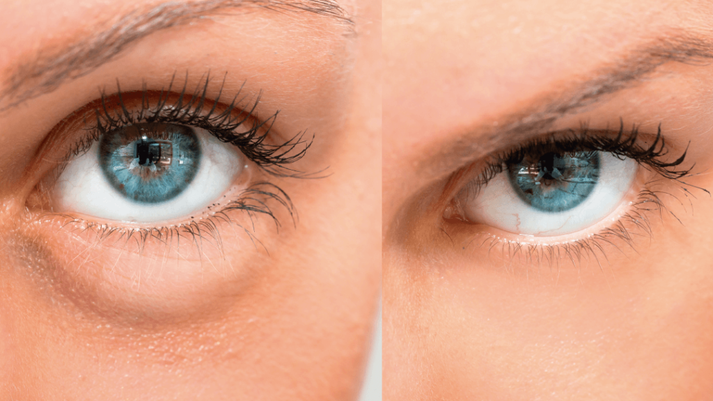 Cómo Eliminar las Bolsas de los Ojos 1 como eliminar las bolsas de los ojos 1