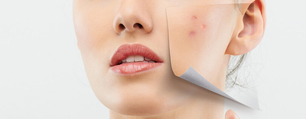 ¿Cómo tener la piel más lisa y sin imperfecciones? Consejos efectivos para una piel impecable 1 como tener la piel mas lisa y sin imperfecciones consejos efectivos para una piel impecable
